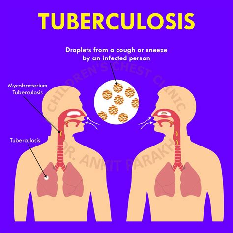 bad tb|Tuberculosis: Causes and How It Spreads